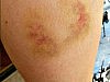 bruised arm