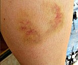 bruised arm